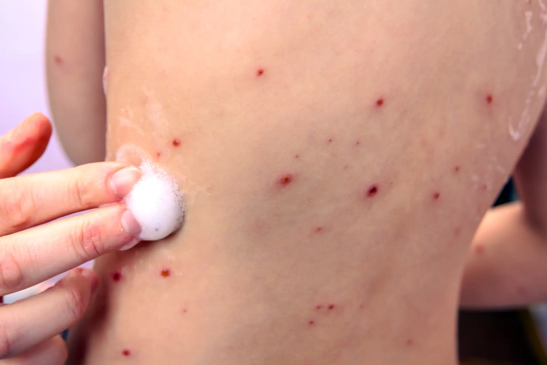 Chicken Pox Scar Revision